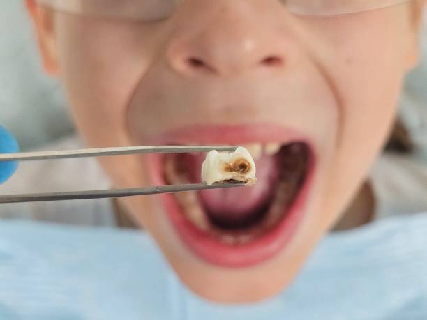 Best Broken Tooth Emergency  in Morton, MS